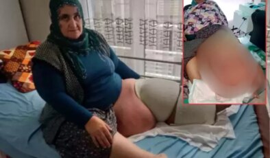 35 yıldır aynı hastalıkla mücadele ediyor! Bacağının ağırlığı 100 kiloya kadar çıktı